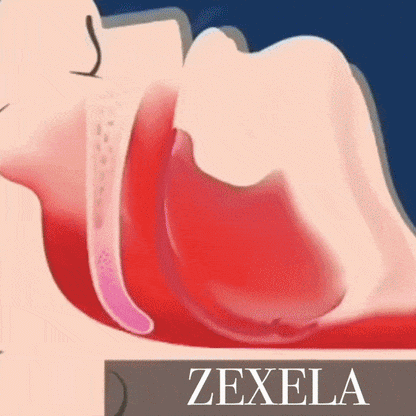 Zexela SilentSleep Anti-Snoring Mouthpiece