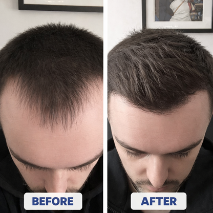 Rosemary Hair Growth Serum Roll-On (25 ml)